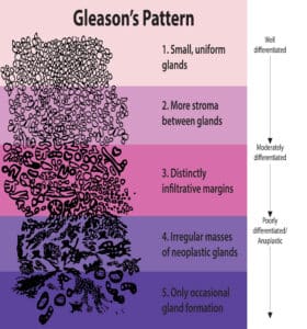 Prostate Cancer Gleason Score
